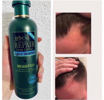 Šampon sa ekstraktom belog luka protiv opadanja kose